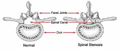 Lumbar Spinal stenosis