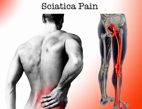 Sciatica Pain And Back Pain