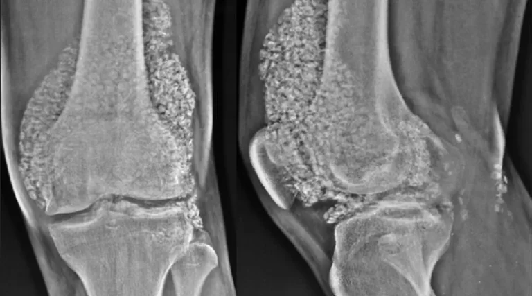 Synovial Chondromatosis