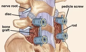 spinal fusion surgery