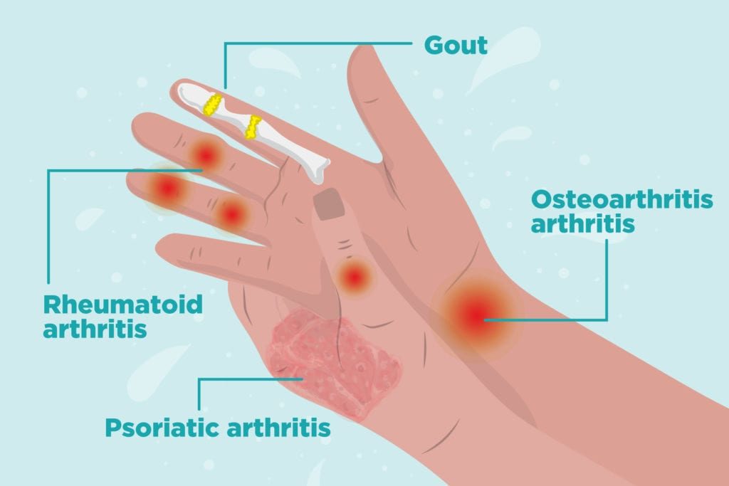 arthritis-of-hand-cause-symptoms-treatment-exercise-samarpan