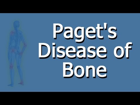 PAGET’S DISEASE OF BONE