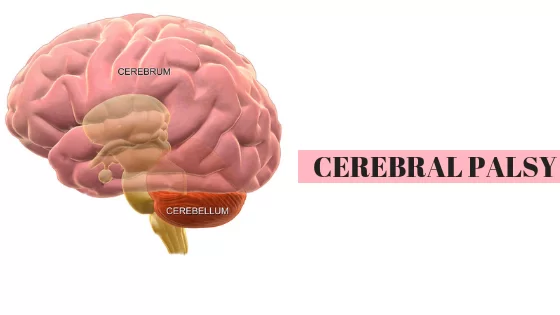 Cerebral Palsy