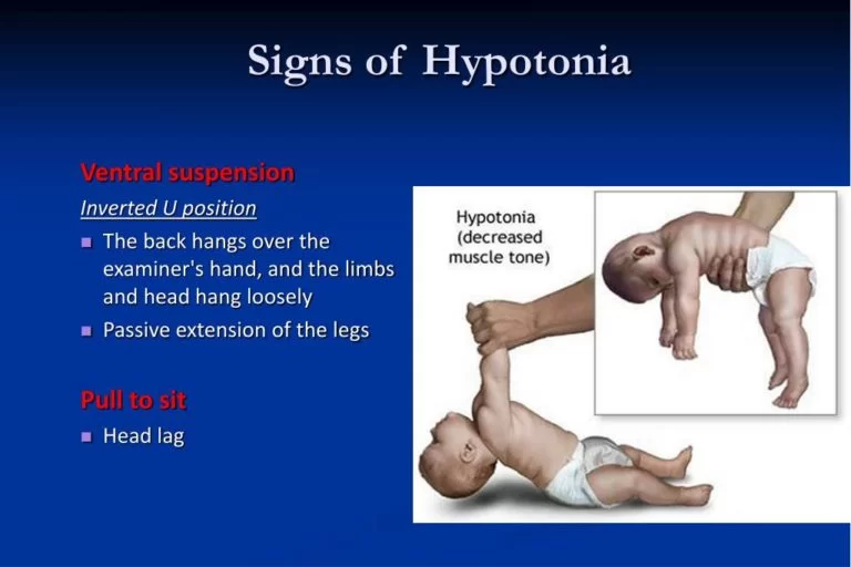hypotonia