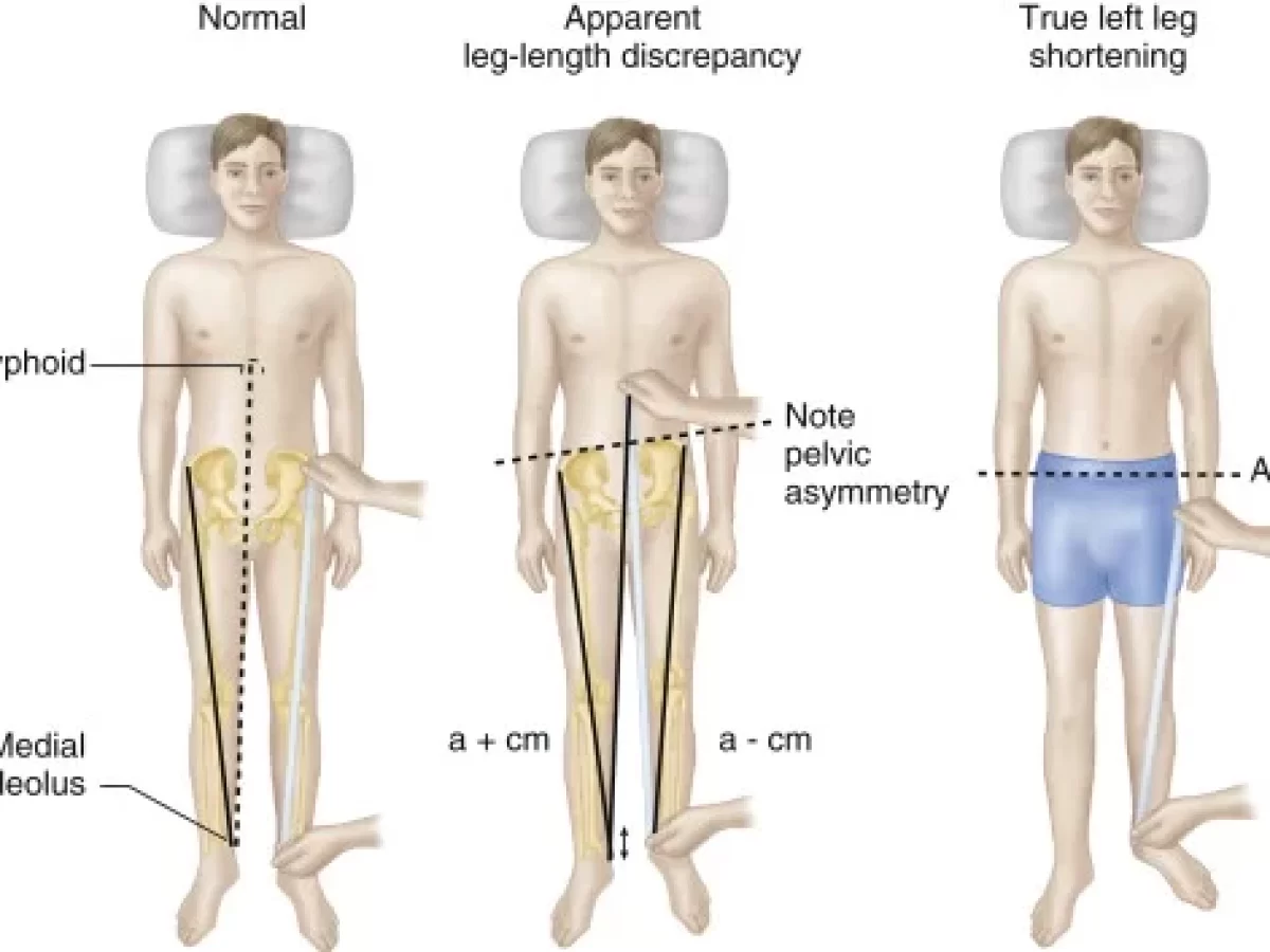 True leg length measurement 