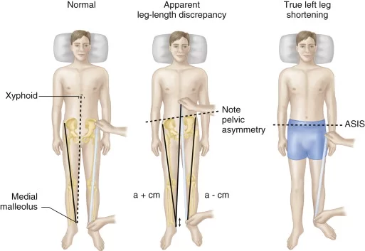 True And Apparent Limb Length discrepancy