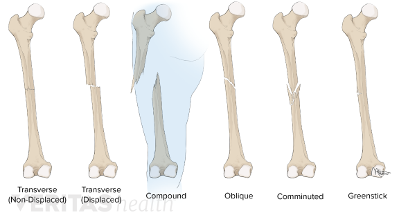 Fracture: Type, Cause, Symptoms, Diagnosis, Treatment