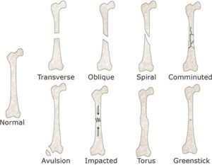 Fracture: Type, Cause, Symptoms, Diagnosis, Treatment