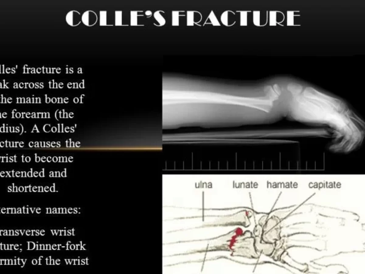 Colles' Fracture  Rehab My Patient