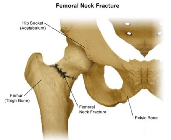 FRACTURE NECK OF FEMURE