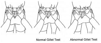 Si Joint Dysfunction Physiotherapy Treatment