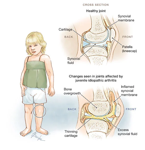 Knee Joint Changes in Juvenile Arthritis