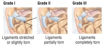 Wrist Sprain Grades