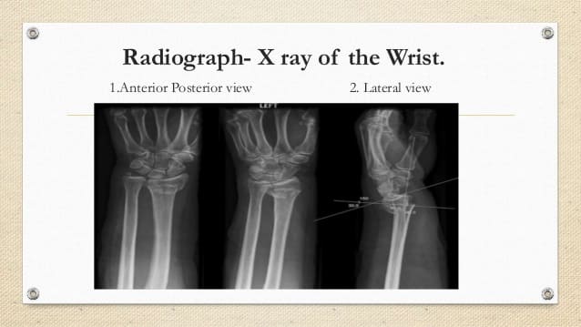 X RAY Anterior Posterior And Lateral View