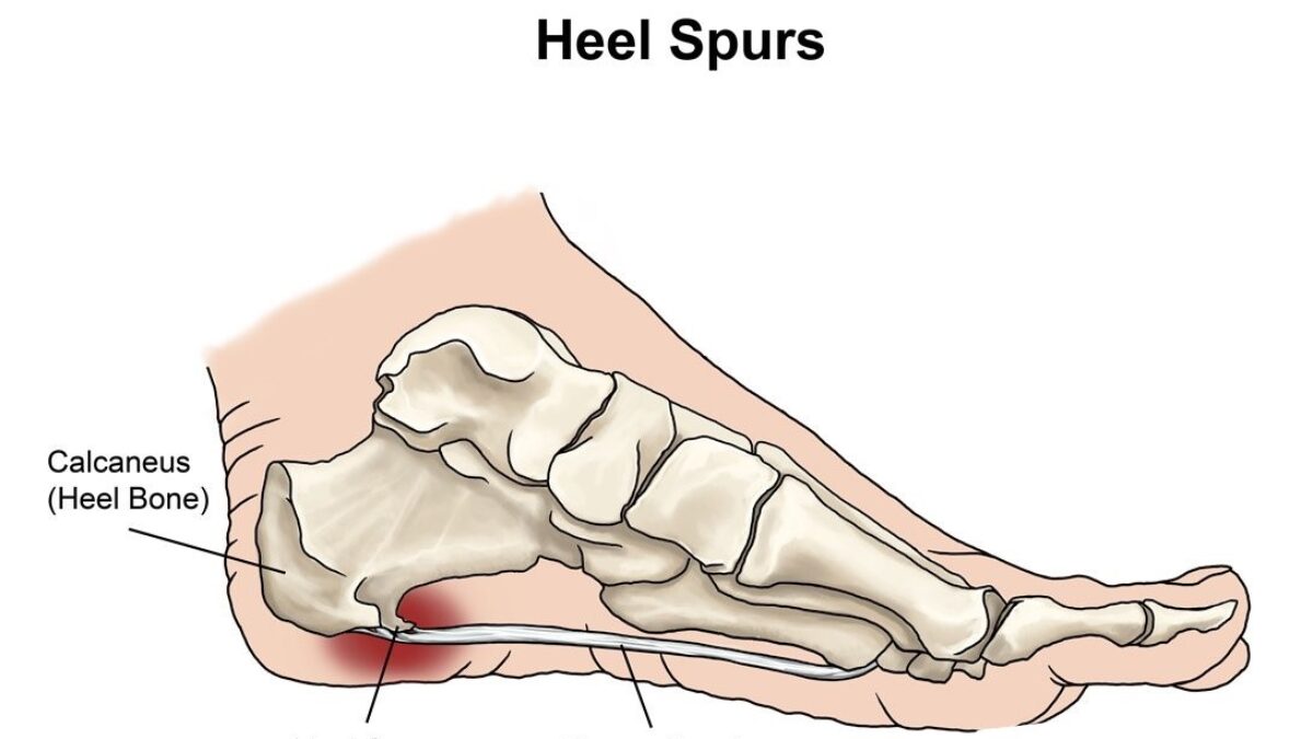 Heel Spur Pain Also Called Calcaneal Spur Physiotherapy Treatment