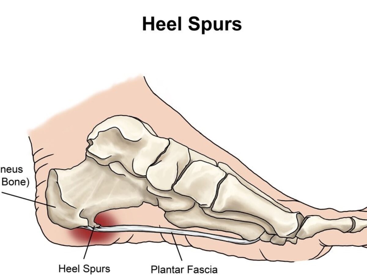 Calcaneal Spur Physiotherapy Treatment