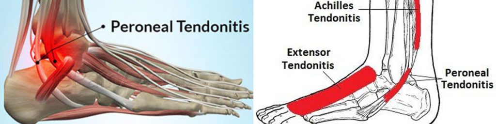 anatomy about Peroneal Tendinitis