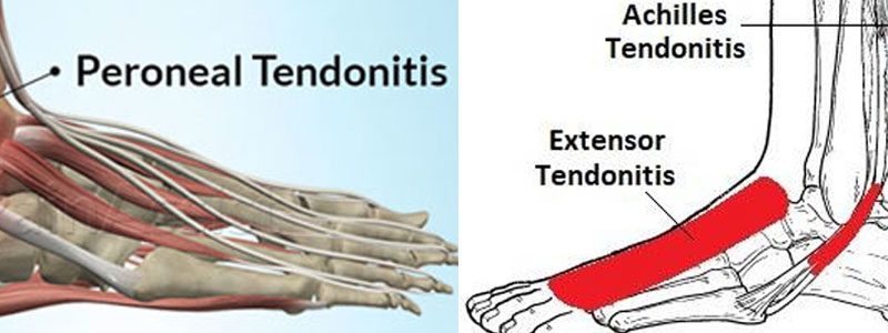 Peroneal Tendinitis Cause Symptom Diagnosis Treatment