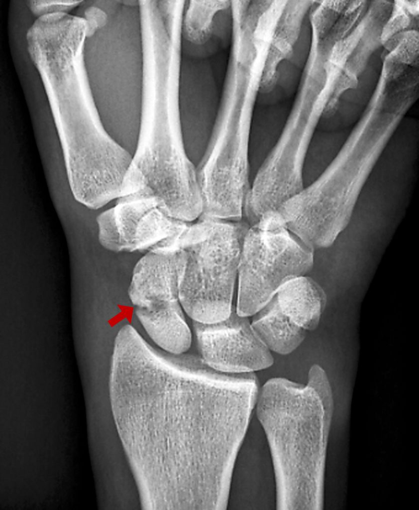 navicular fracture wrist