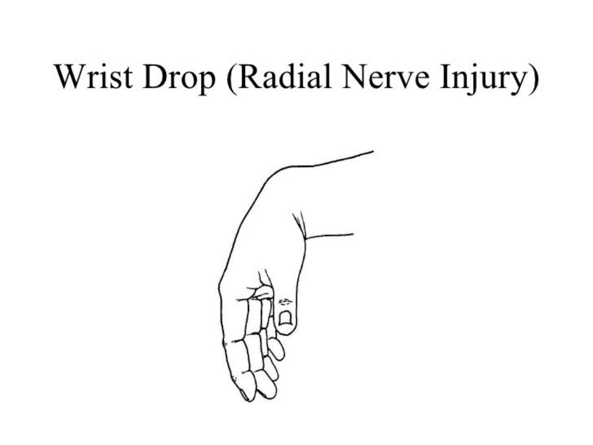 Wrist Drop Cause, Symptoms,Diagnosis, Treatment, Exercise