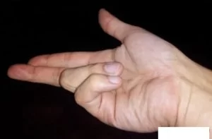 Claw Hand Symptoms