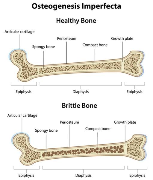 OSTEOGENESIS IMPERFECTA - SAMARPAN PHYSIOTHERAPY CLINIC AHMEDABAD