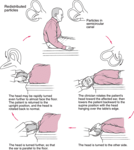 Epley Maneuver ( Physiotherapy Exercise Technique Of Vertigo )