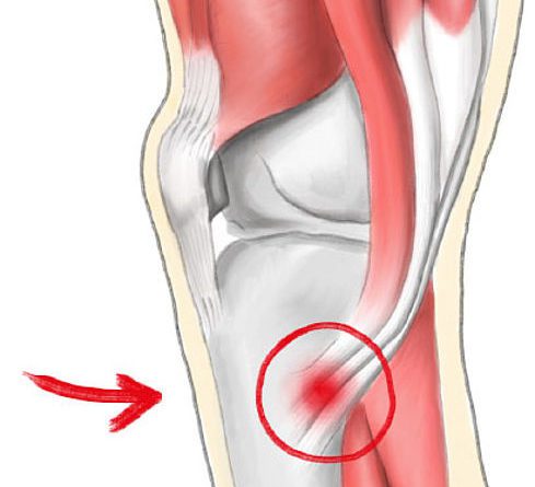 pes bursitis