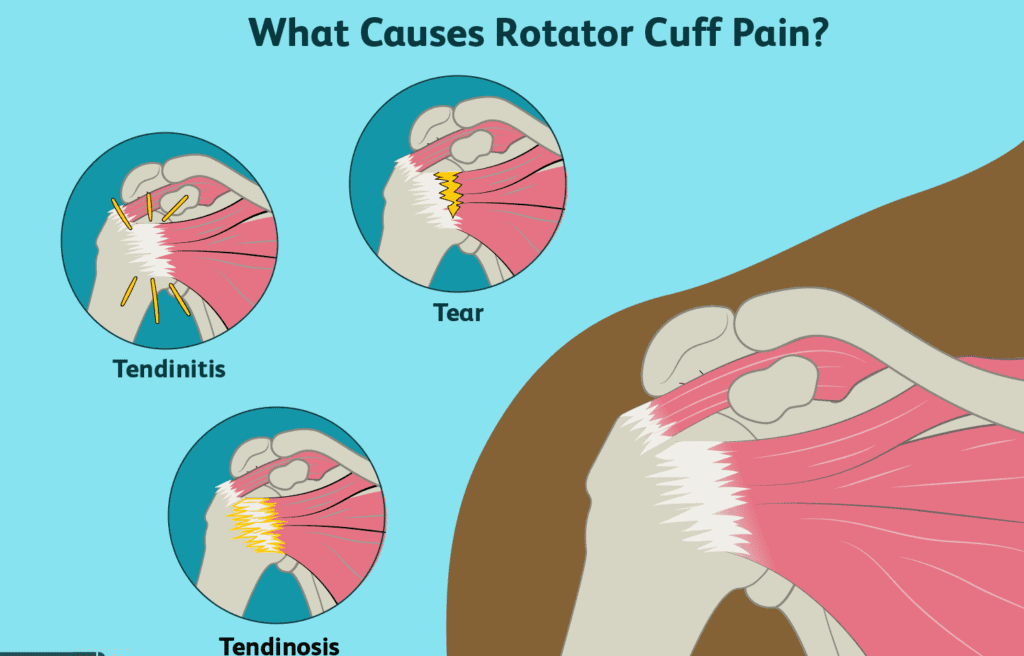 rotator-cuff-samarpan-physiotherapy-clinic-ahmedabad