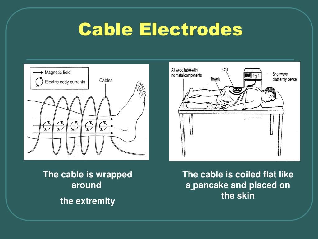 Cable Electrodes