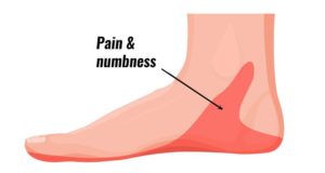 Tarsal Tunnel Syndrome : Cause, Symptoms, Diagnosis, Treatment