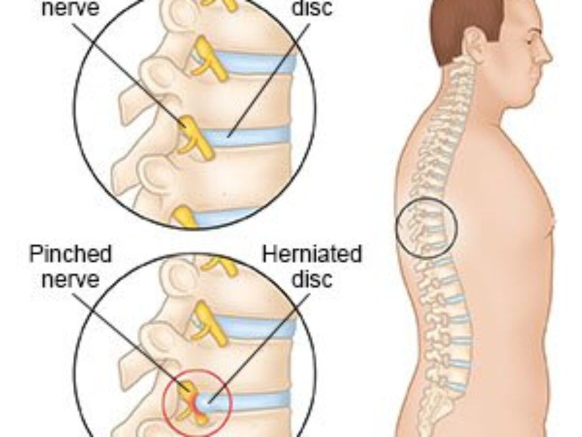 Nerve Pain in the Thoracic Spine - Causes and Treatments