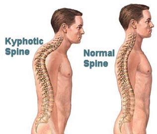 kyphosis posture