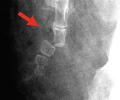 coccyx fracture