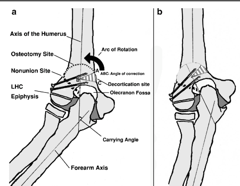 Cubitus Varus Deformity: