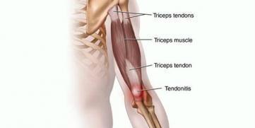 tricep tendonitis