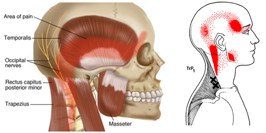Anatomy of cervicogenic headache
