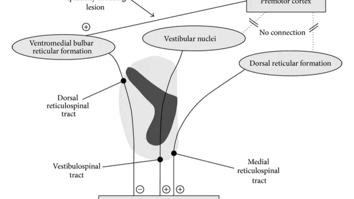 Iliotibial band syndrome (ITBS or IT band syndrome) is an overuse