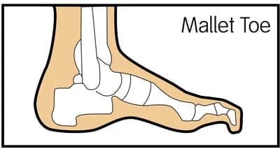 Mallet toe