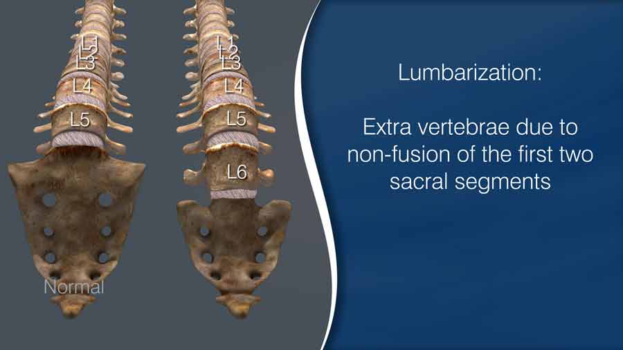 lumbarization-cause-symptom-s-diagnosis-treatment-exercise