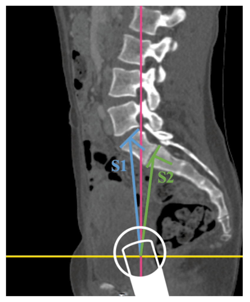X Ray of lumbar spine