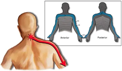 Neck to Shoulder pain