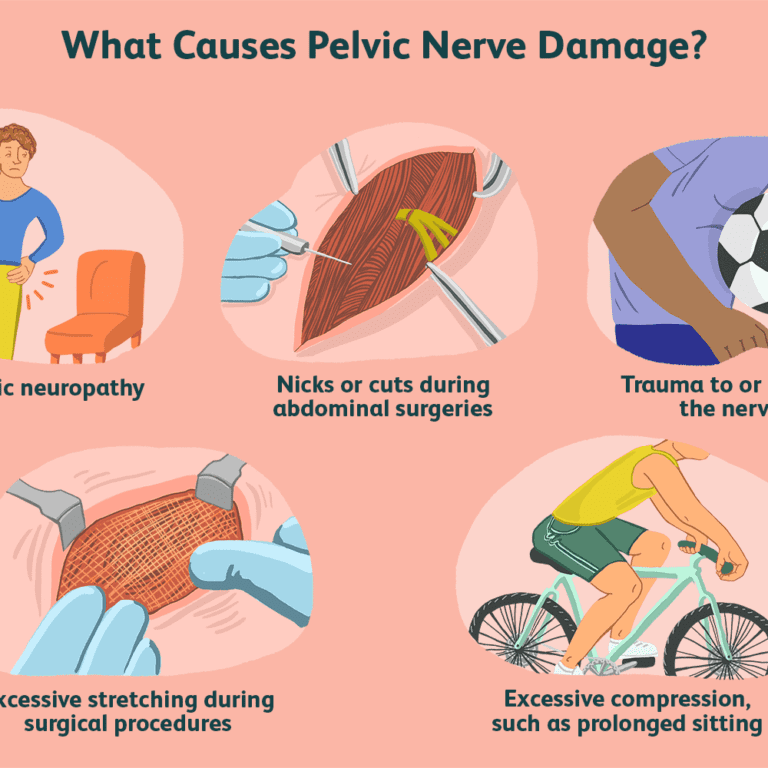 Pudendal Nerve Entrapment Syndromes Physiotherapy Treatmentexercise 