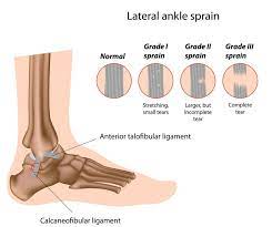 grades-of-ankle-sprain