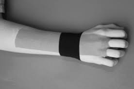 KINESIO TAPPING FOR WRIST SPRAIN : KT Taping