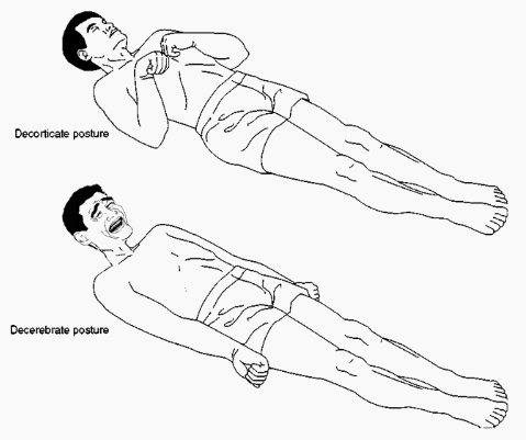 Decerebrate posture vs Decorticate posture