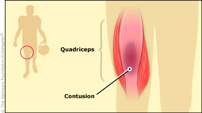 Contusions