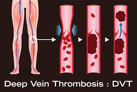 Calf pain: Cause, Symptoms, Diagnosis, Treatment, Exercise - Samarpan