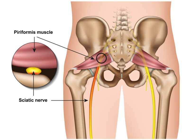 Dowager's Hump - Causes, Symptoms, Treatment - Samarpan