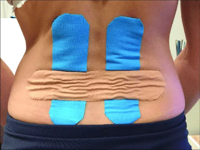 kinesio taping for back pain